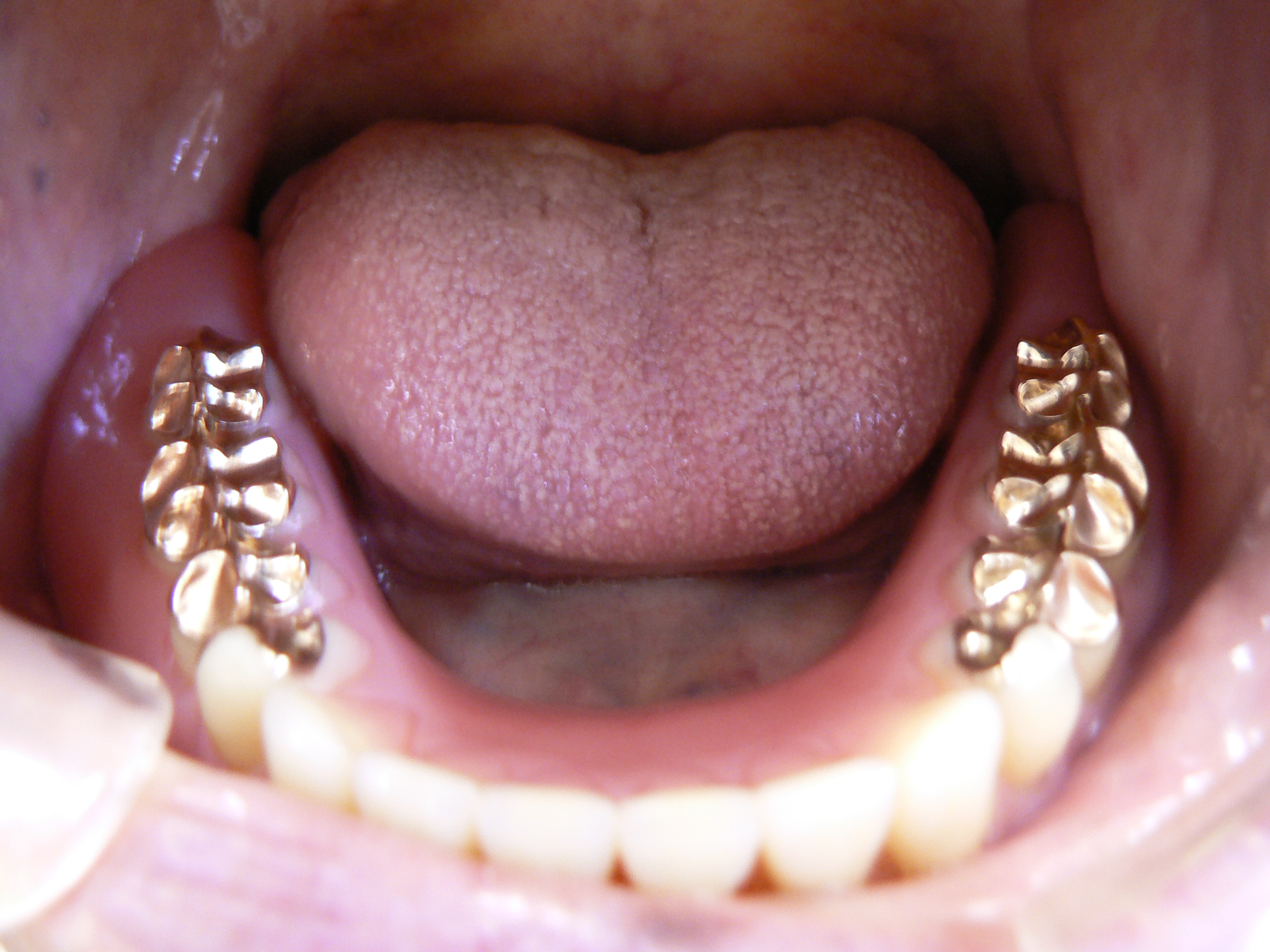 究極の総義歯について