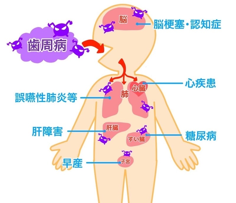 歯周病と全身との関係