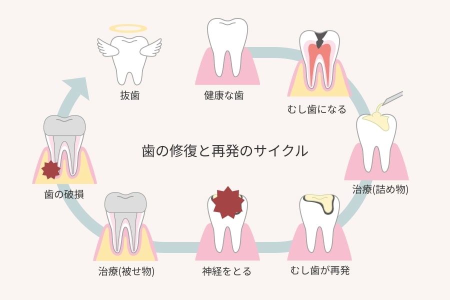 歯の修復と再発のサイクル